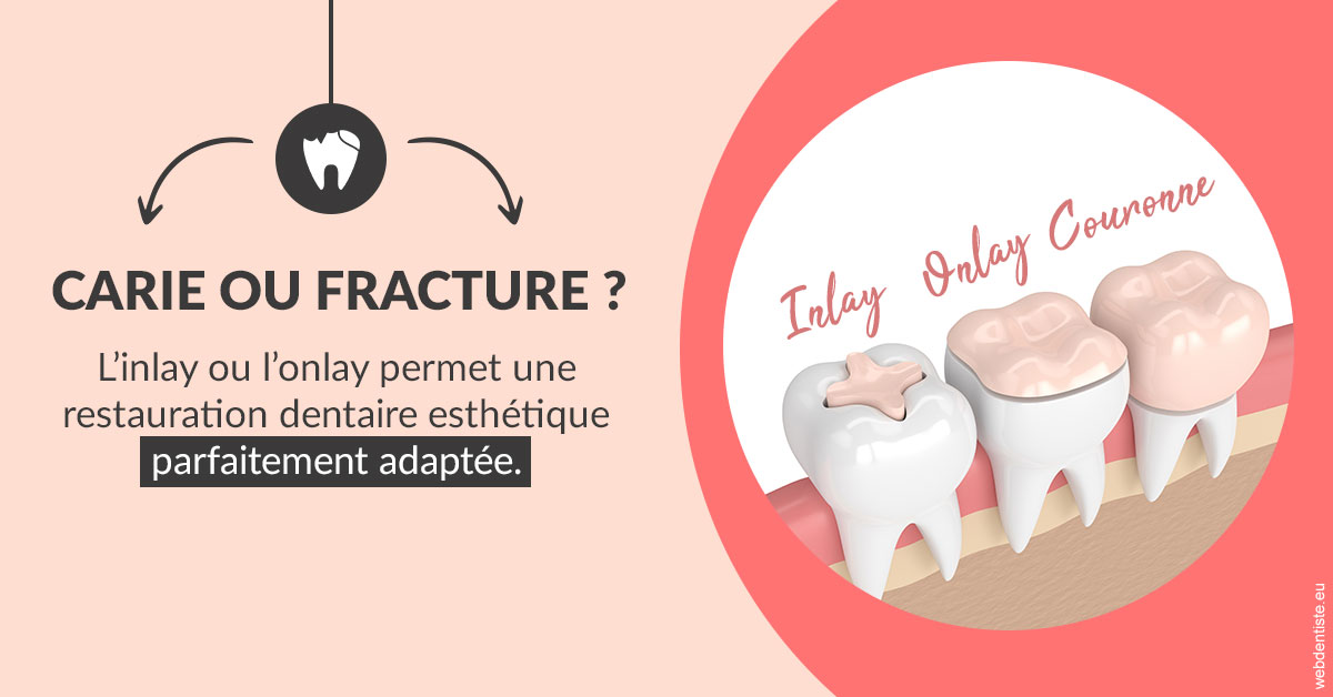 https://dr-madar-fabrice.chirurgiens-dentistes.fr/T2 2023 - Carie ou fracture 2