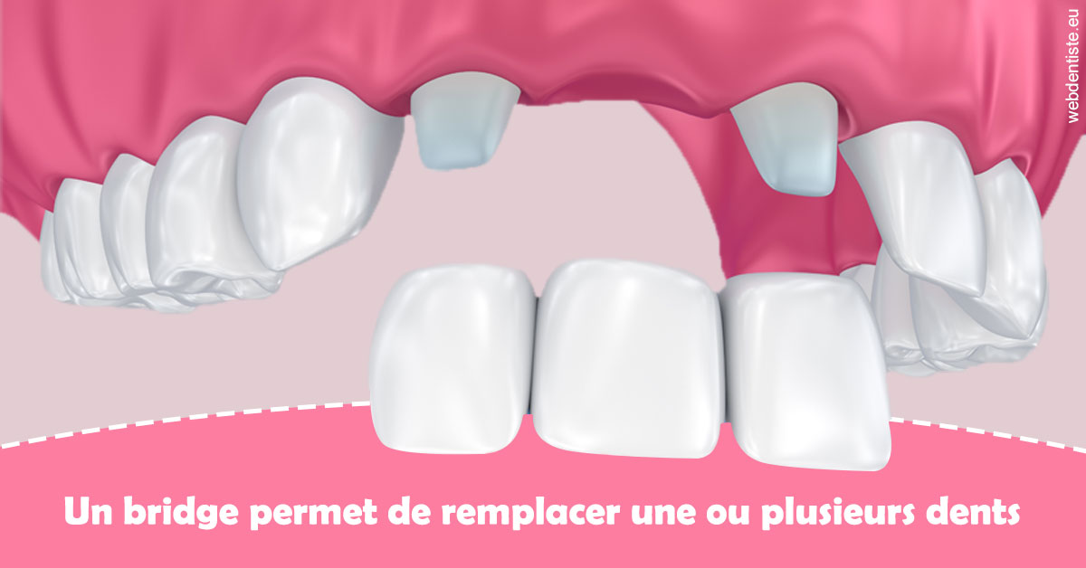 https://dr-madar-fabrice.chirurgiens-dentistes.fr/Bridge remplacer dents 2