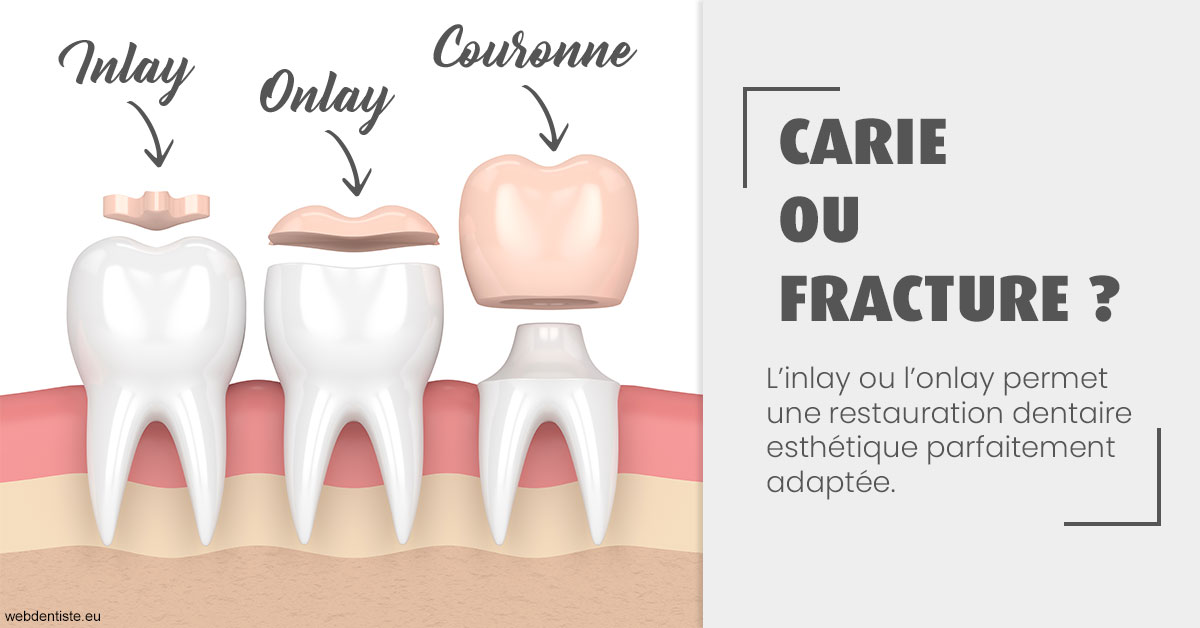 https://dr-madar-fabrice.chirurgiens-dentistes.fr/T2 2023 - Carie ou fracture 1