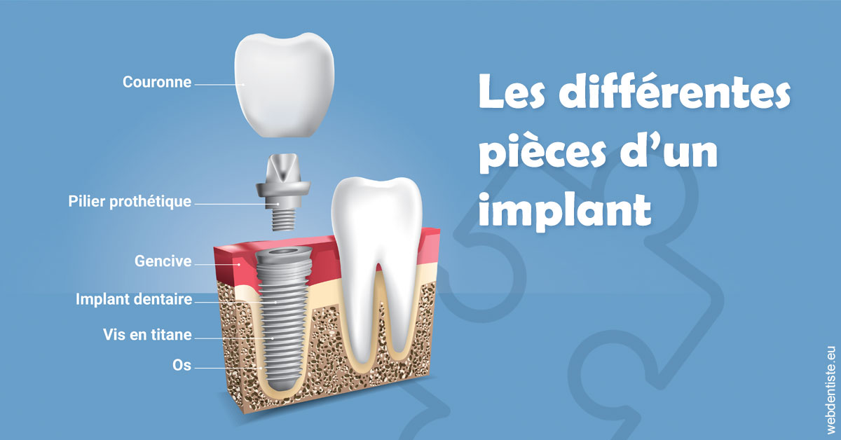 https://dr-madar-fabrice.chirurgiens-dentistes.fr/Les différentes pièces d’un implant 1
